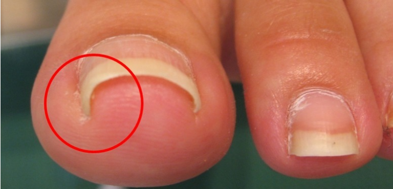 Ingrown Toenail