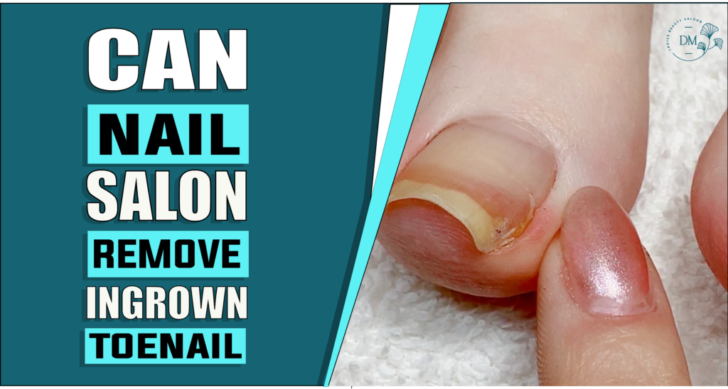 Can Nail Salon Remove Ingrown Toenail